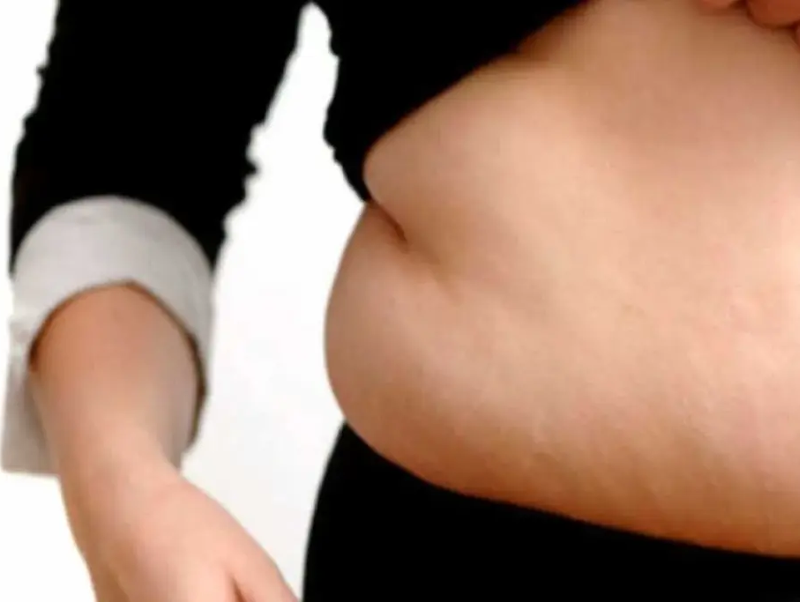 Understanding Cushing Syndrome: Causes, Symptoms, and Treatment Options