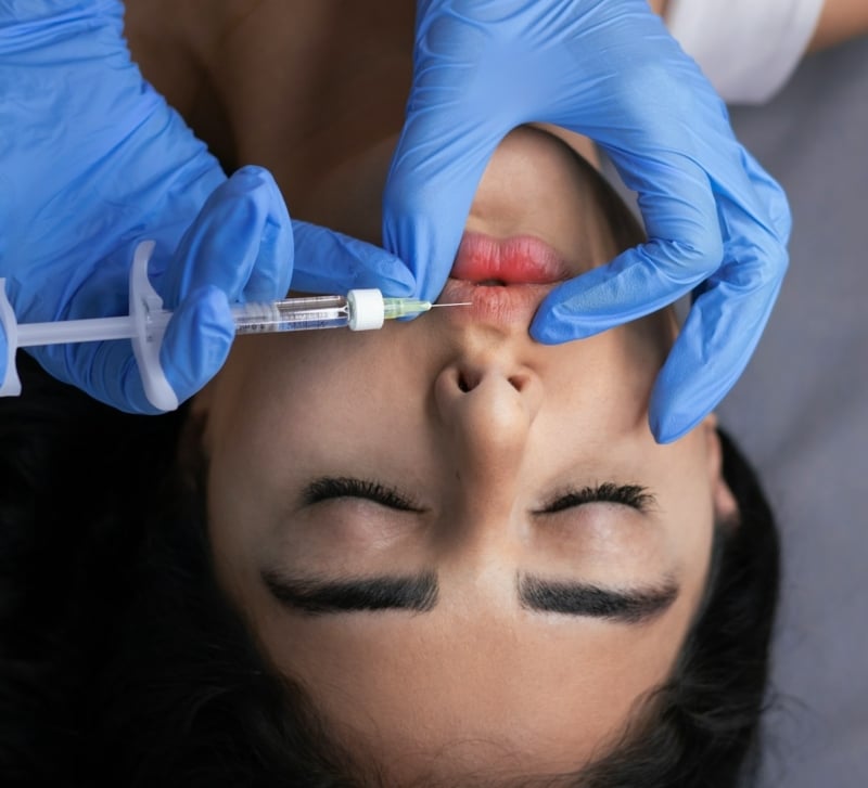 How Choosing Hyaluronic Acid Based Lip Filler at Anne Therese Enhances Lip Volume
